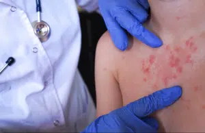 Alerta en Colombia por riesgo de aumento de sarampión: expertos y autoridades insisten en reforzar vacunación para evitar brotes