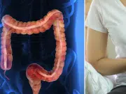 Expertos aclaran los riesgos del consumo excesivo de ultraprocesados: ¿pueden causar cáncer?