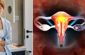 Ovario poliquístico: los dos síntomas clave que podrían indicarle el síndrome antes de que se dé cuenta