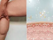 Lipedema: la enfermedad frecuente que se confunde con celulitis y obesidad