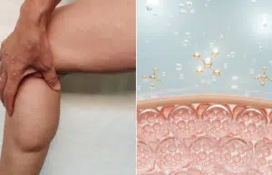 Lipedema: la enfermedad frecuente que se confunde con celulitis y obesidad