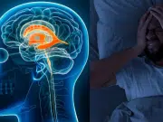 El dolor de cabeza que desaparece al acostarse: una señal temprana de hipotensión intracraneal, patología que puede deteriorar la calidad de vida