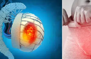 Cáncer testicular: los cuatro síntomas del ‘bulto silencioso’ que más afectan a hombres jóvenes
