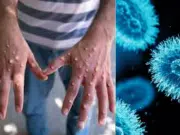 Minsalud confirma el primer caso de ‘viruela del mono’ (mpox) clado 1B en Colombia