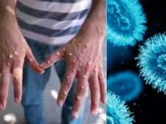 Minsalud confirma el primer caso de ‘viruela del mono’ (mpox) clado 1B en Colombia