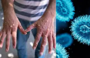 Minsalud confirma el primer caso de ‘viruela del mono’ (mpox) clado 1B en Colombia