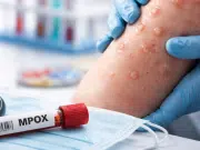 Qué es la viruela símica (mpox clado ld), síntomas y cómo se contagia: MinSalud confirmó primer caso de nueva variante en Colombia