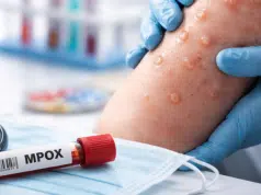 Qué es la viruela símica (mpox clado ld), síntomas y cómo se contagia: MinSalud confirmó primer caso de nueva variante en Colombia