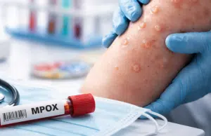 Qué es la viruela símica (mpox clado ld), síntomas y cómo se contagia: MinSalud confirmó primer caso de nueva variante en Colombia
