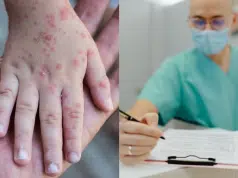 ¿Cuáles son los efectos de la viruela símica?: conozca su gravedad, qué personas son más vulnerables, y cómo prevenirla