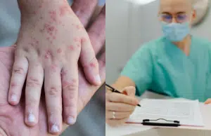 ¿Cuáles son los efectos de la viruela símica?: conozca su gravedad, qué personas son más vulnerables, y cómo prevenirla