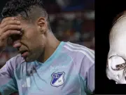 ¿Qué es el arco cigomático? La lesión que sufrió Radamel Falcao García en el partido entre Millonarios y América de Cali
