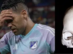 ¿Qué es el arco cigomático? La lesión que sufrió Radamel Falcao García en el partido entre Millonarios y América de Cali