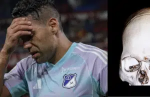 ¿Qué es el arco cigomático? La lesión que sufrió Radamel Falcao García en el partido entre Millonarios y América de Cali