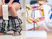 Cáncer de colon: así cambian las heces cuando algo no está bien y las señales que podrían alertar un problema grave a tiempo