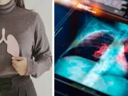 ¿Cuándo una tos deja de ser común? Cinco síntomas persistentes que pueden alertar sobre cáncer de pulmón y requieren evaluación médica