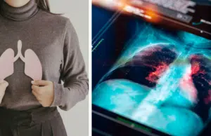 ¿Cuándo una tos deja de ser común? Cinco síntomas persistentes que pueden alertar sobre cáncer de pulmón y requieren evaluación médica