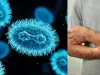 Confirman segundo caso de mpox clado Ib en Colombia: detectado en Bogotá y sin transmisión comunitaria