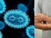 Confirman segundo caso de mpox clado Ib en Colombia: detectado en Bogotá y sin transmisión comunitaria