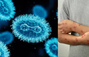 Confirman segundo caso de mpox clado Ib en Colombia: detectado en Bogotá y sin transmisión comunitaria
