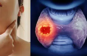 Hipotiroidismo e hipertiroidismo: las señales de alerta de la tiroides que toda mujer colombiana debe conocer