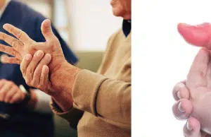 Las primeras señales de la artritis que las personas suelen pasar por alto y cómo comenzar a prevenir la enfermedad