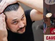 ¿Si utiliza gorra se puede quedar calvo? Expertos en dermatología responden a varios mitos sobre la alopecia