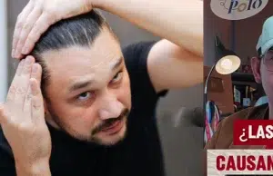 ¿Si utiliza gorra se puede quedar calvo? Expertos en dermatología responden a varios mitos sobre la alopecia