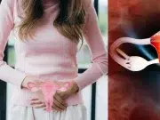 Médicos anuncian cambio en el nombre oficial del Síndrome de Ovario Poliquístico: la medida para proteger la salud de la población femenina
