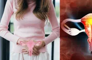 Médicos anuncian cambio en el nombre oficial del Síndrome de Ovario Poliquístico: la medida para proteger la salud de la población femenina
