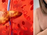 Estudio revela que el hígado graso eleva en un 69 % el riesgo de infarto y complicaciones cardiovasculares