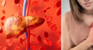 Estudio revela que el hígado graso eleva en un 69 % el riesgo de infarto y complicaciones cardiovasculares