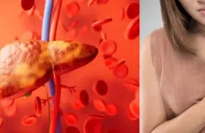 Estudio revela que el hígado graso eleva en un 69 % el riesgo de infarto y complicaciones cardiovasculares