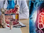 Cinco señales silenciosas del cáncer de colon que no se deben ignorar, según experto médico