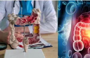 Cinco señales silenciosas del cáncer de colon que no se deben ignorar, según experto médico