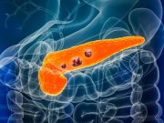 Desarrollan un test de sangre que promete detectar el cáncer de páncreas en minutos