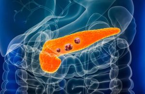 Desarrollan un test de sangre que promete detectar el cáncer de páncreas en minutos