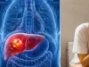 Las ‘pistas del baño’ que muchas personas ignoran y que podrían estar relacionadas con el cáncer de hígado