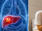 Las ‘pistas del baño’ que muchas personas ignoran y que podrían estar relacionadas con el cáncer de hígado