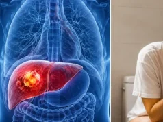 Las ‘pistas del baño’ que muchas personas ignoran y que podrían estar relacionadas con el cáncer de hígado