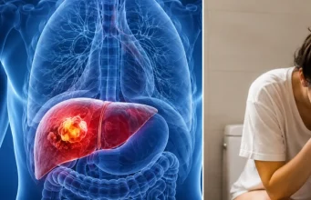 Las ‘pistas del baño’ que muchas personas ignoran y que podrían estar relacionadas con el cáncer de hígado