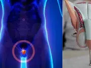Cáncer de próstata: síntomas y cómo detectarlo antes de que avance