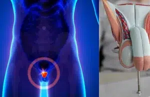 Cáncer de próstata: síntomas y cómo detectarlo antes de que avance