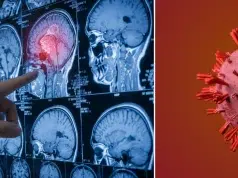 El cáncer cerebral puede empezar así: cinco señales tempranas que suelen pasar desapercibidas antes del diagnóstico