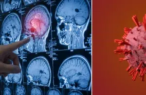 El cáncer cerebral puede empezar así: cinco señales tempranas que suelen pasar desapercibidas antes del diagnóstico