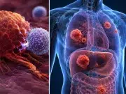 Más del 90 % de la población mundial se verá afectada de alguna forma por el cáncer, según las investigaciones avaladas por la OMS