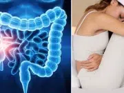 Cáncer de colon en mujeres: siete síntomas que pueden confundirse con la menstruación, según estudios