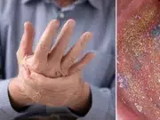 Salud bucal: el vínculo inesperado entre la microbiota oral y la artritis en las manos, según estudio chino
