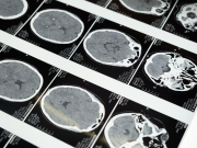 CORRE+: guía para detectar un accidente cerebro vascular